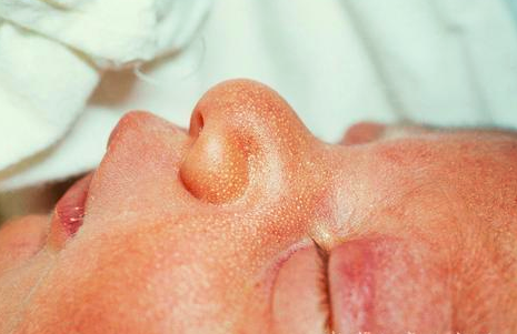 新生儿高发的3种皮肤病症